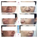 Pre-and-post-pictures-of-our-patient-after-single-sitting-of-freckle-removal-laser-150x150 Gallery