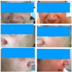 pre-and-post-pictures-of-our-patient-after-2-sittings-of-hydra-peel-treatment-150x150 Gallery