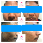 pre-and-post-pictures-of-our-patient-after-3-sittings-of-carbon-blackout-laser-150x150 Gallery