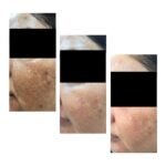 pre-and-post-pictures-of-our-patient-after-3-sittings-of-medical-peeling-sessions-Silk-peel-treatments-150x150 Gallery
