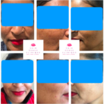 pre-post-pictures-of-our-patient-after-4-sittings-of-glow-and-pigmentation-peels-treatment-150x150 Gallery